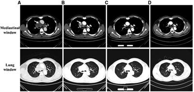 Large mediastinal mass diagnosed as Nocardia infection by endobronchial ultrasound-guided transbronchial needle aspiration in a ceramic worker: A case report